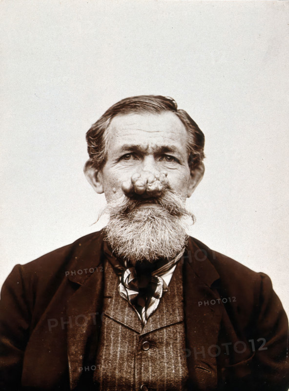 A patient of Léon Desguin, before operation, c1890s. Creator: Unknown.