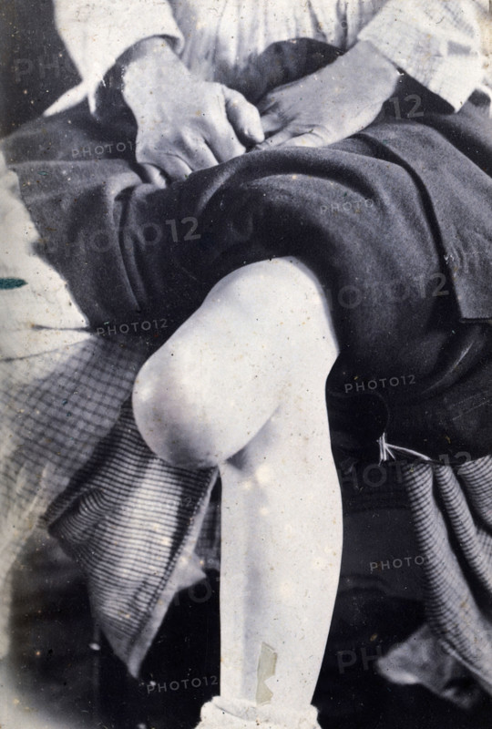Friern Hospital, London: the knee of a seated person, with a large growth,  1890-1910. Creator: Unknown.