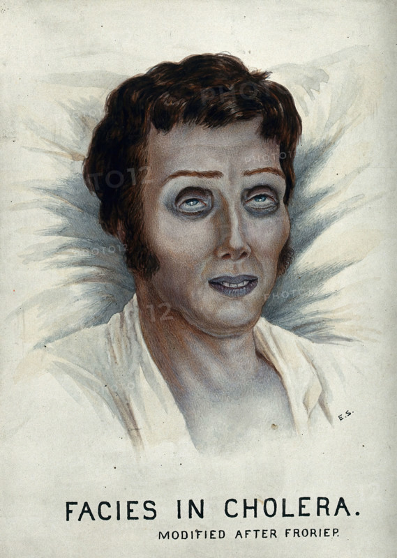 A cholera victim with a typical facial appearance, 1920-1950. Creator: Unknown.
