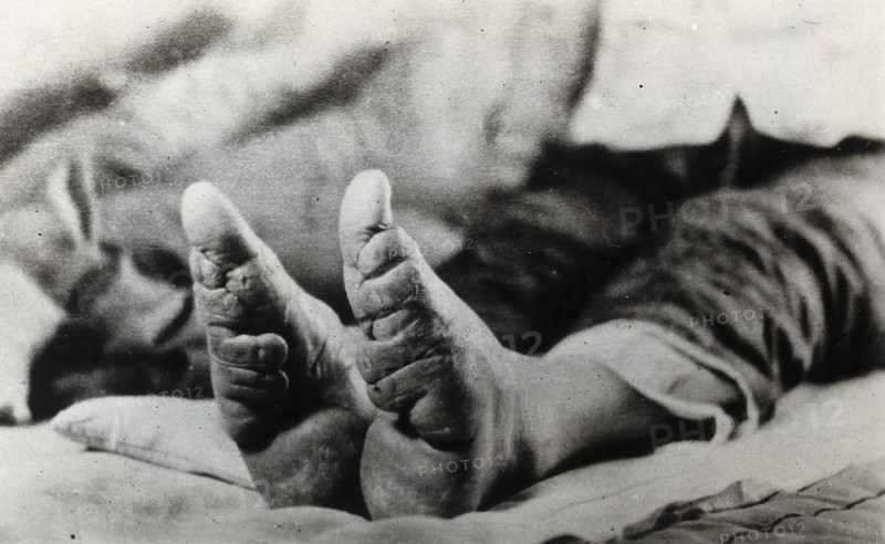 Feet of a Chinese woman, showing the effect of foot-binding, between 1900 and 1999. Creator: Unknown.