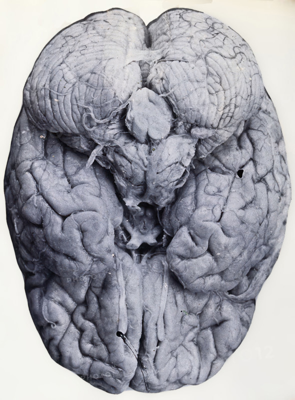 Friern Hospital, London: a brain, 1890-1910. Creator: Unknown.
