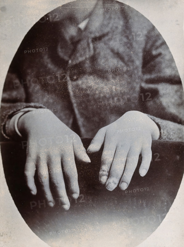 The hands of a child, showing deformity, particularly around the fingertips, c1890s. Creator: N. Goulton May.