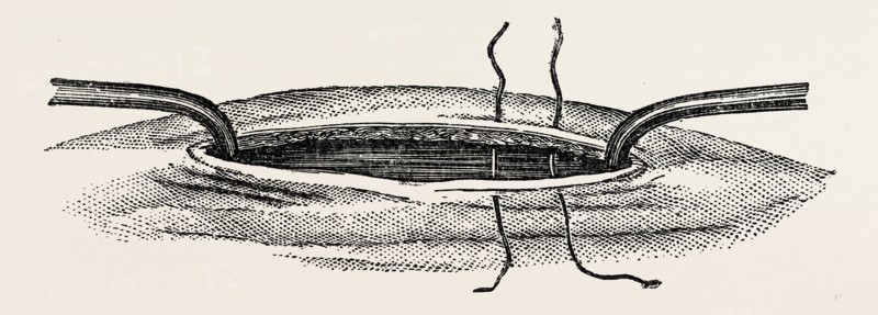method of steadying the margins of a wound with blunt hooks, medical equipment, surgical instrument, history of medicine