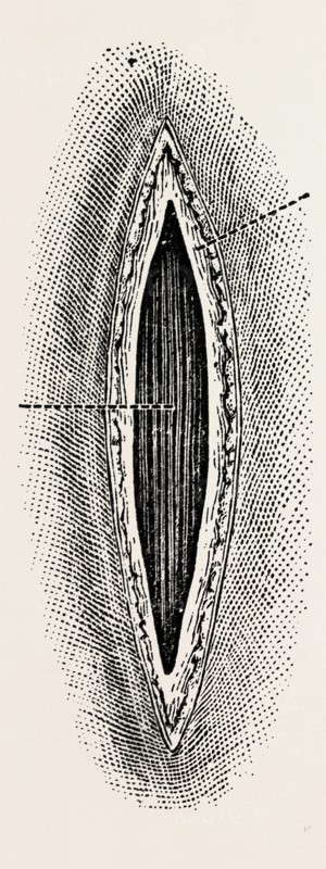 ligatuite of the right radial, medical equipment, surgical instrument, history of medicine