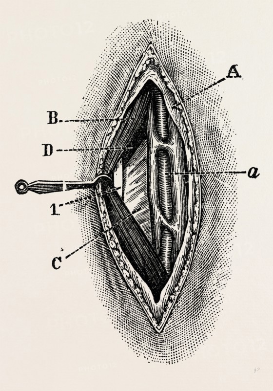 ligatuite of the right radial, medical equipment, surgical instrument, history of medicine