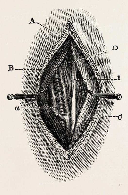 ligature, medical equipment, surgical instrument, history of medicine