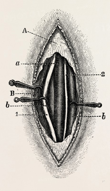 ligature of the right finger, medical equipment, surgical instrument, history of medicine