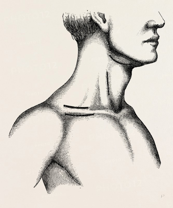 ligature of the first part, medical equipment, surgical instrument, history of medicine
