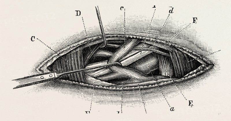 ligature of the right subclavian ernird part, medical equipment, surgical instrument, history of medicine