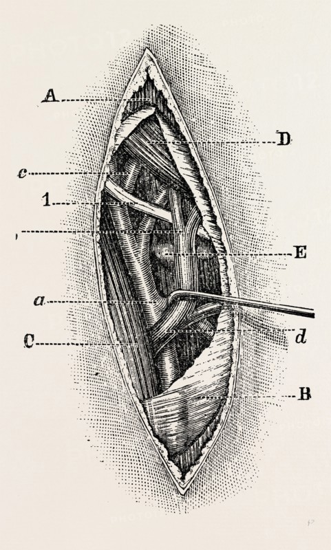ligature, medical equipment, surgical instrument, history of medicine