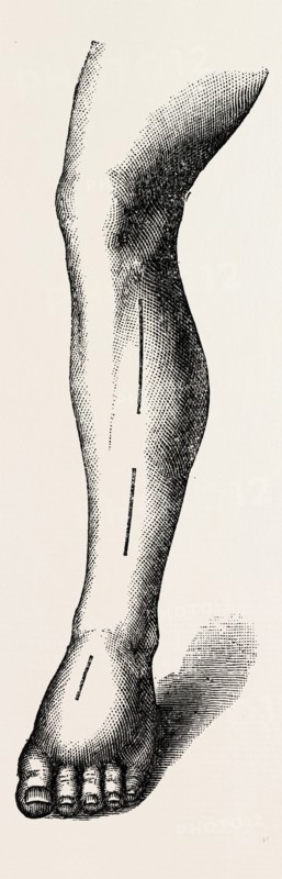 ligature, medical equipment, surgical instrument, history of medicine