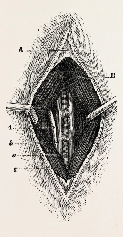 tractor, the outer border of the ligature, medical equipment, surgical instrument, history of medicine