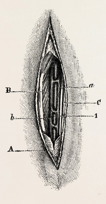 ligature, medical equipment, surgical instrument, history of medicine