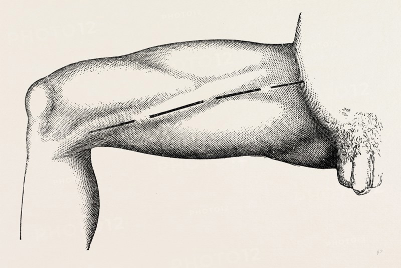 ligature of the right common femoral at the base of scarpa's, medical equipment, surgical instrument, history of medicine