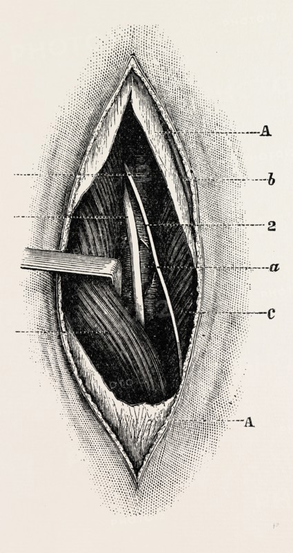 ligature of, femoral are the long saphenous nerve, medical equipment, surgical instrument, history of medicine