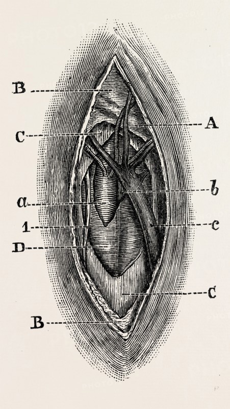 ligature, medical equipment, surgical instrument, history of medicine