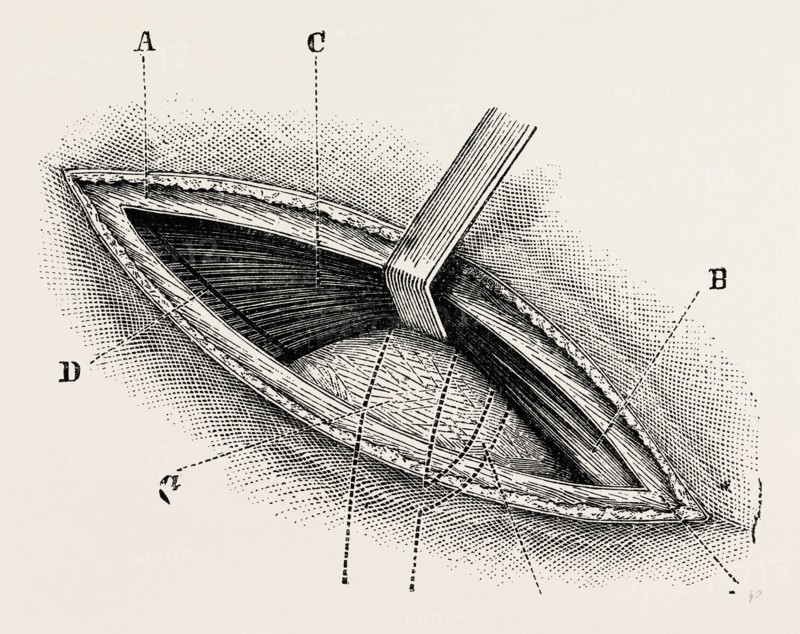 ligature of right external iliac artery, medical equipment, surgical instrument, history of medicine
