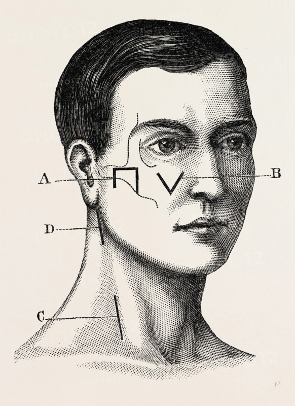 a neurotomy of third division, medical equipment, surgical instrument, history of medicine
