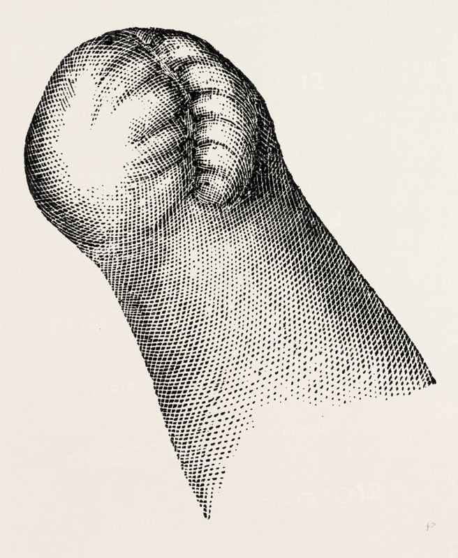 stump of right, medical equipment, surgical instrument, history of medicine