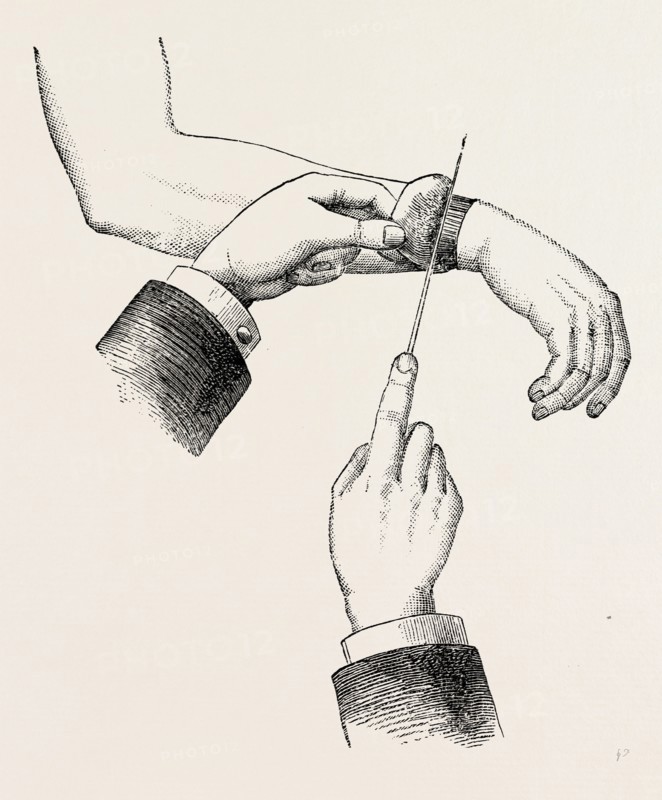 circular amputation de la manchette, medical equipment, surgical instrument, history of medicine