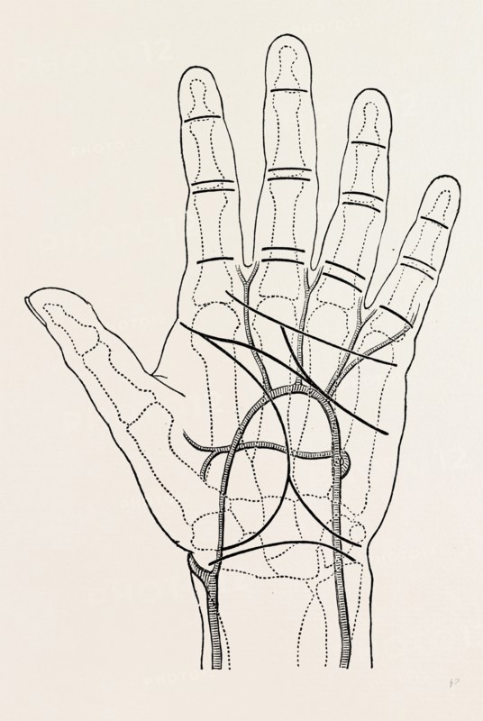 surface markings on the palm of ffile hand, the thick black lines represent the chief creases of the skin, medical equipment, surgical instrument, history of medicine