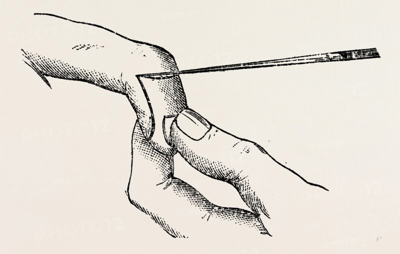 four inches long, a fine key, the mode of holding, medical equipment, surgical instrument, history of medicine
