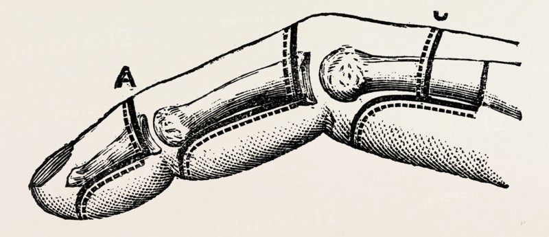 disarticulations, medical equipment, surgical instrument, history of medicine