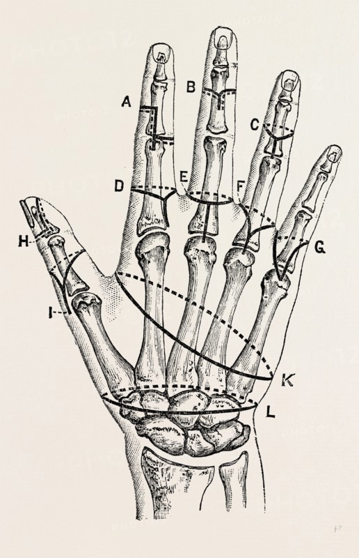 disarticulation by single external, medical equipment, surgical instrument, history of medicine