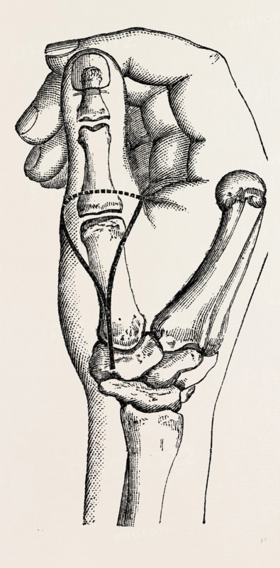 disarticulation, medical equipment, surgical instrument, history of medicine
