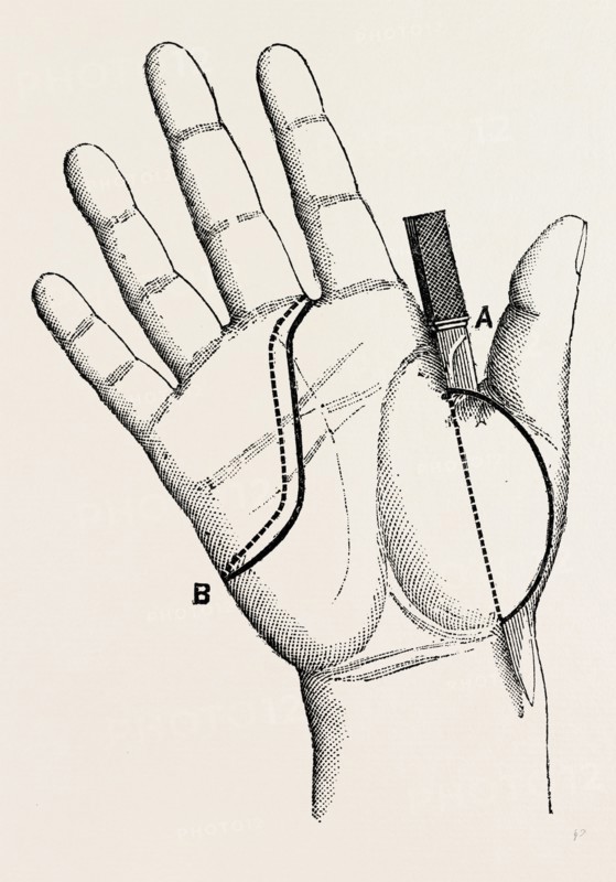 disartieulation of the thumb, medical equipment, surgical instrument, history of medicine