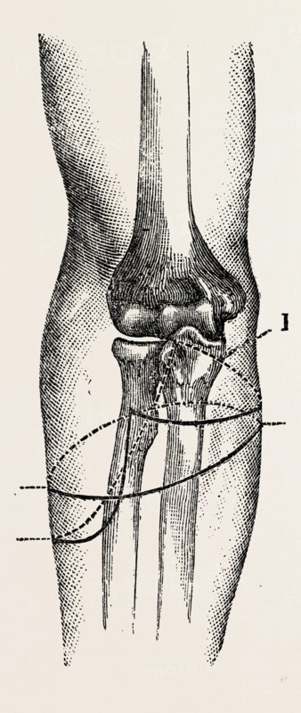 disarticulation, medical equipment, surgical instrument, history of medicine