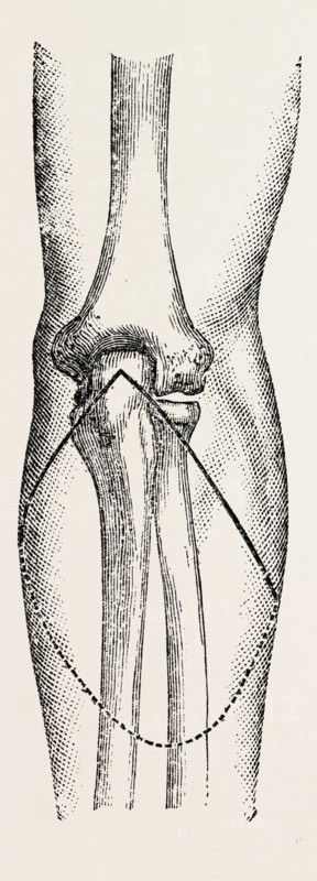 disarticu- ikemorritage.Ã¢â‚¬â€ùin addition to muscular, medical equipment, surgical instrument, history of medicine
