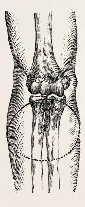 disarticulation, medical equipment, surgical instrument, history of medicine