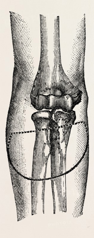 disarticulation, medical equipment, surgical instrument, history of medicine