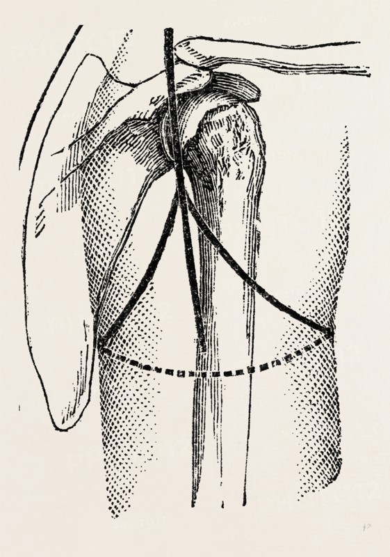 disaetictjlation at the posterior part of the oval, medical equipment, surgical instrument, history of medicine