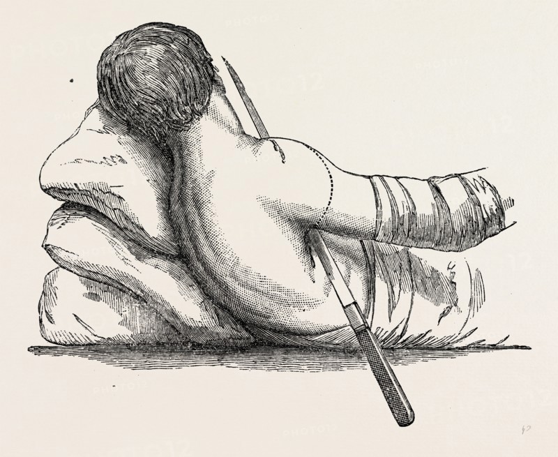amputation at the shoulder-joint by transfixion, from fergusson's, medical equipment, surgical instrument, history of medicine