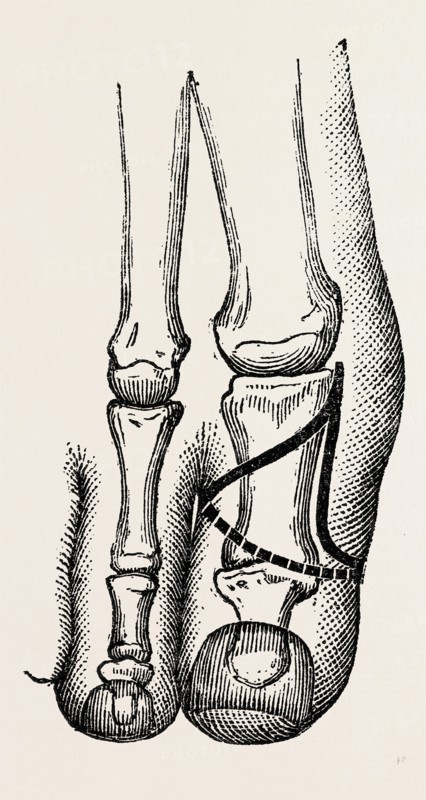 disarticulation, medical equipment, surgical instrument, history of medicine