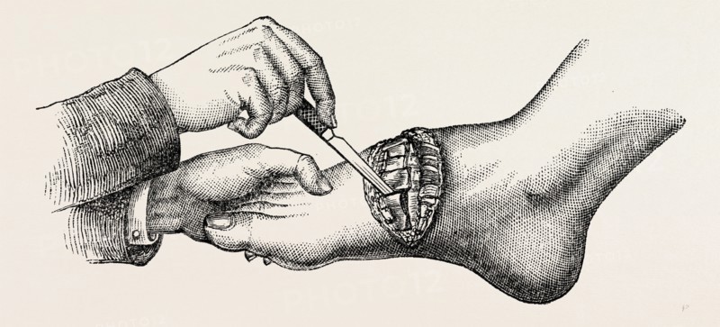 the coup de maitre in lisfrancis amputation, first step, medical equipment, surgical instrument, history of medicine