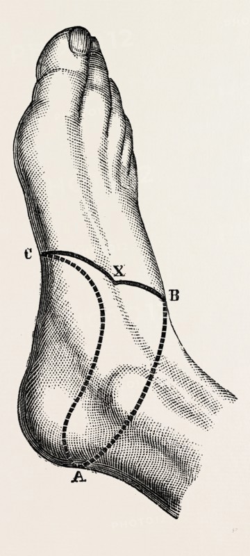 inner and outer sides of the right foot, to show the incisions, medical equipment, surgical instrument, history of medicine
