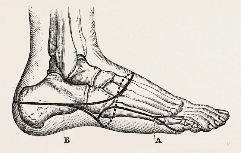 disarticulation of the little toe, medical equipment, surgical instrument, history of medicine