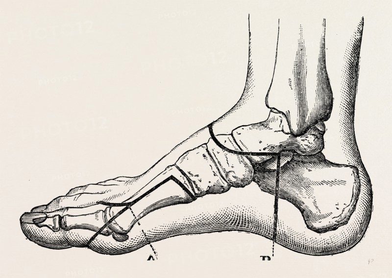 disarticulation of the great toe, medical equipment, surgical instrument, history of medicine
