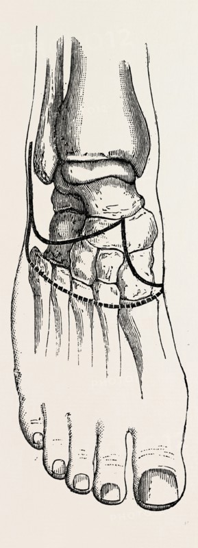 tripier's, medical equipment, surgical instrument, history of medicine