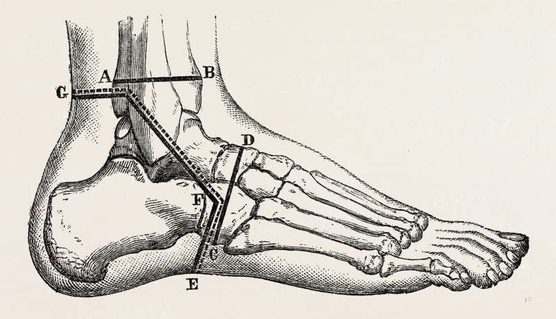 osteo-plastic resection of the foot, medical equipment, surgical instrument, history of medicine