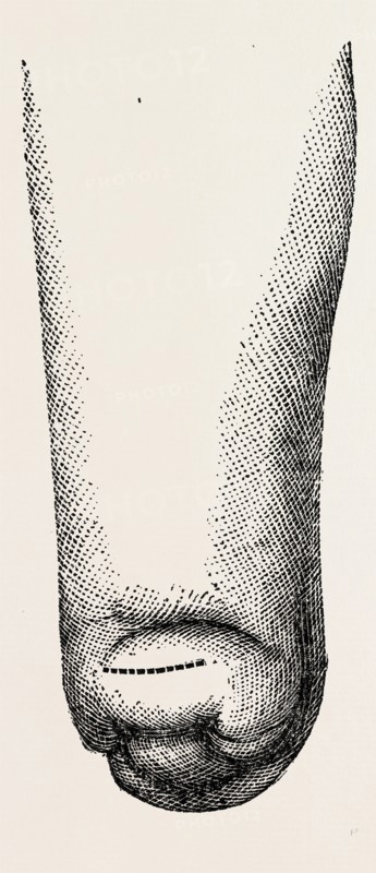 stump, medical equipment, surgical instrument, history of medicine
