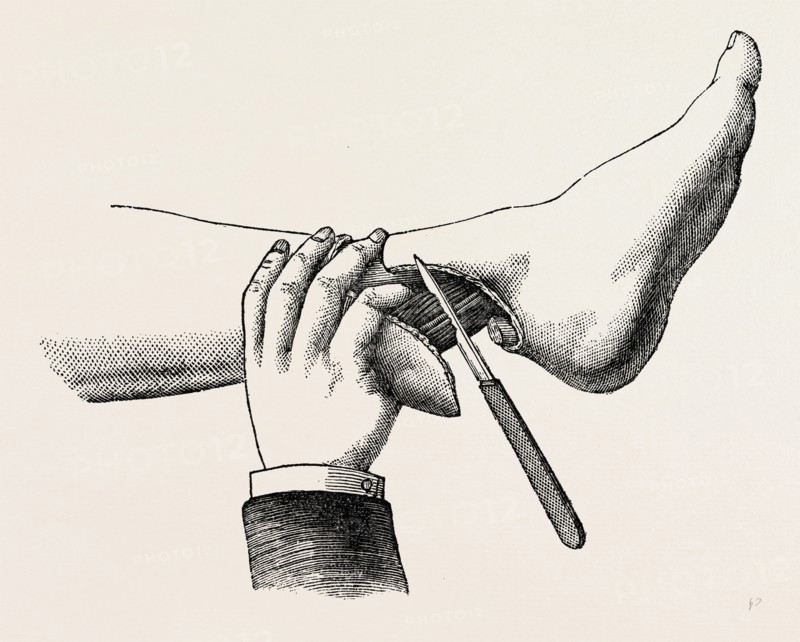 mode of dividing the tissues in the amputation, medical equipment, surgical instrument, history of medicine