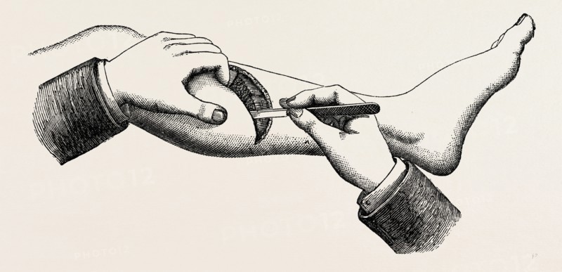 mode of cutting the flap in the amputation at 44, medical equipment, surgical instrument, history of medicine