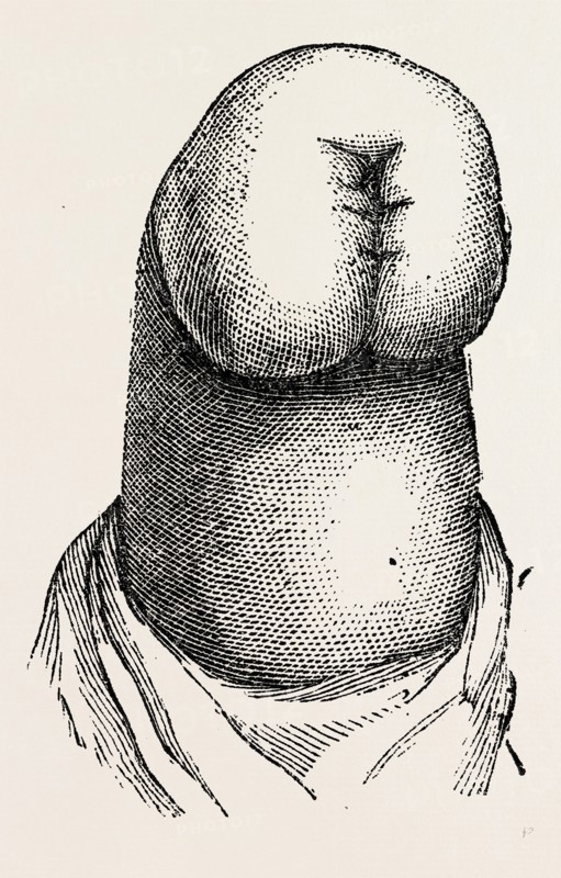the stump, medical equipment, surgical instrument, history of medicine