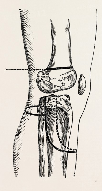 farabeuf's amputation, medical equipment, surgical instrument, history of medicine