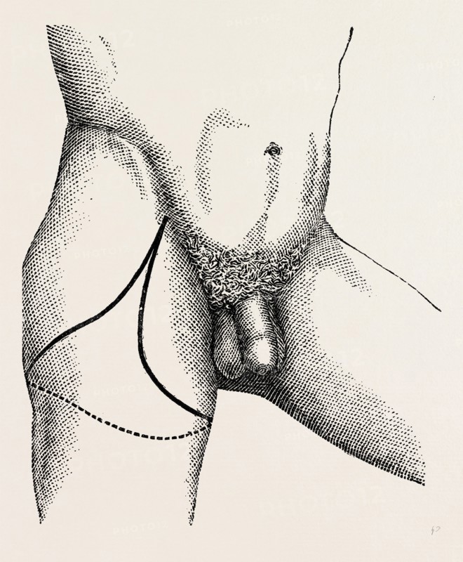 disarticulation, medical equipment, surgical instrument, history of medicine
