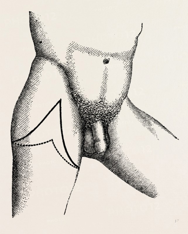 lisfrancs disarticulation, medical equipment, surgical instrument, history of medicine